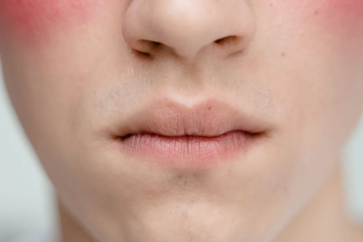 Close-up of the nose and cheeks. Illustrative stock photo, not a treatment result.