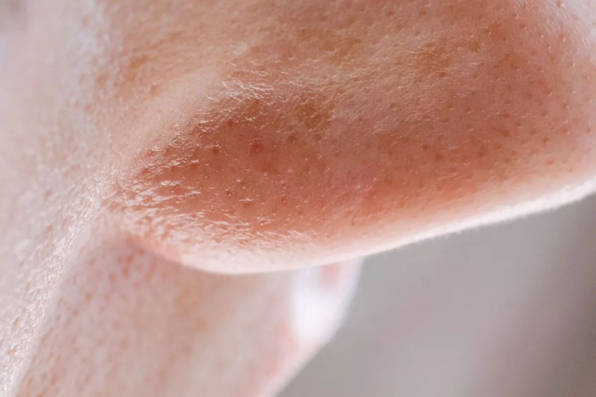 Close-up of skin on the side of the nose showing pores, not a treatment result