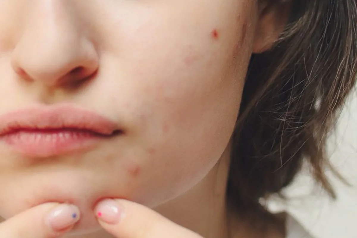 Close-up of chin acne being indicated, not an acne-scar or treatment-result photo