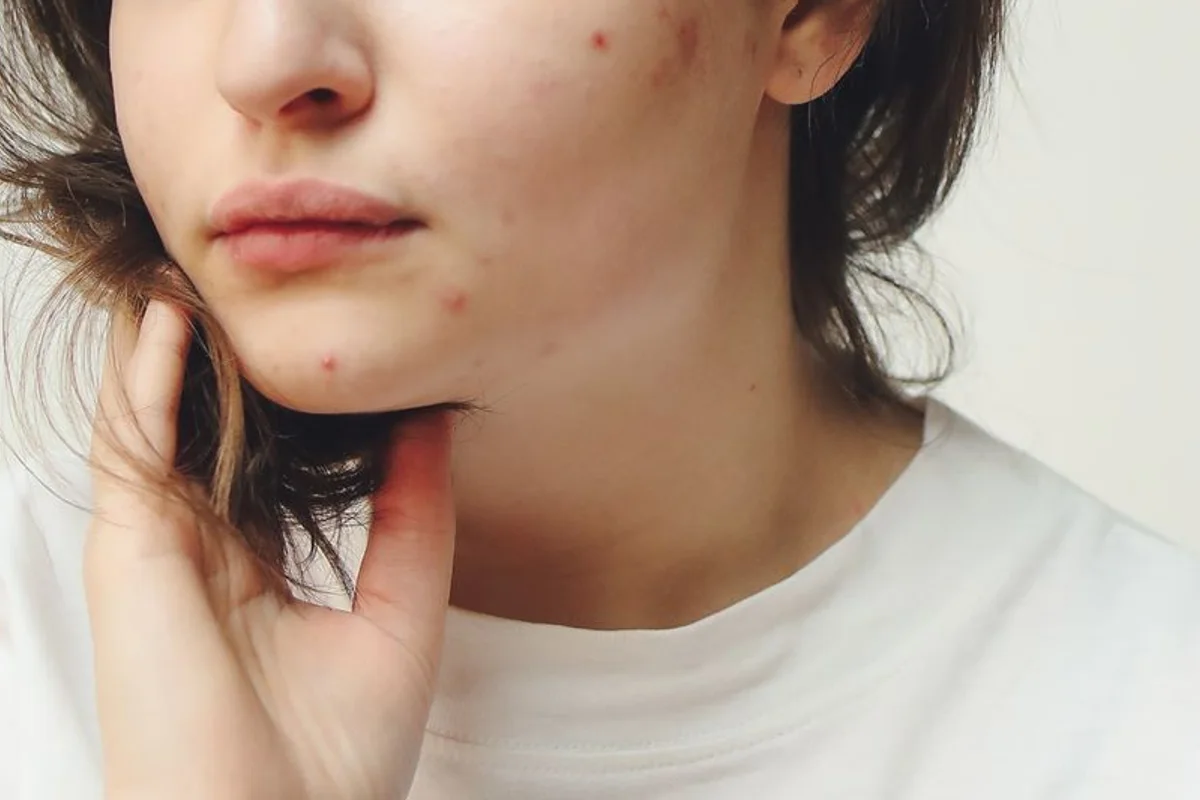 Close-up of acne marks on the lower cheek and chin, not a treatment result