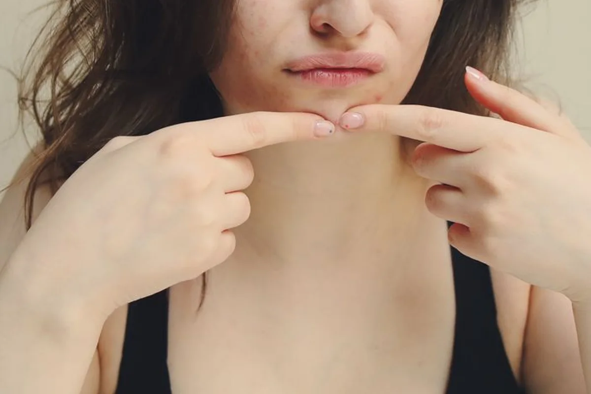 Close-up of a blemish on the chin being indicated, not a scar or treatment-result photo