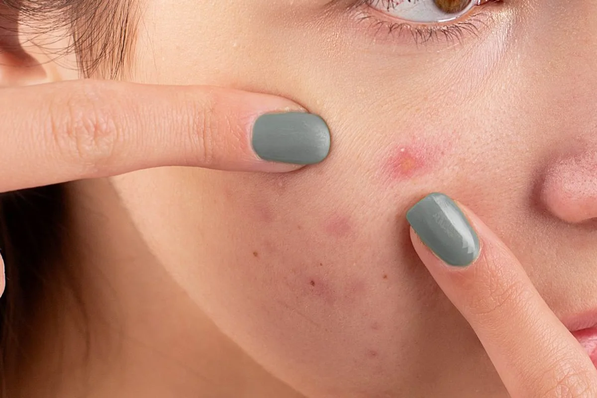 Close-up of a cheek blemish being indicated, not an acne-scar or treatment-result photo