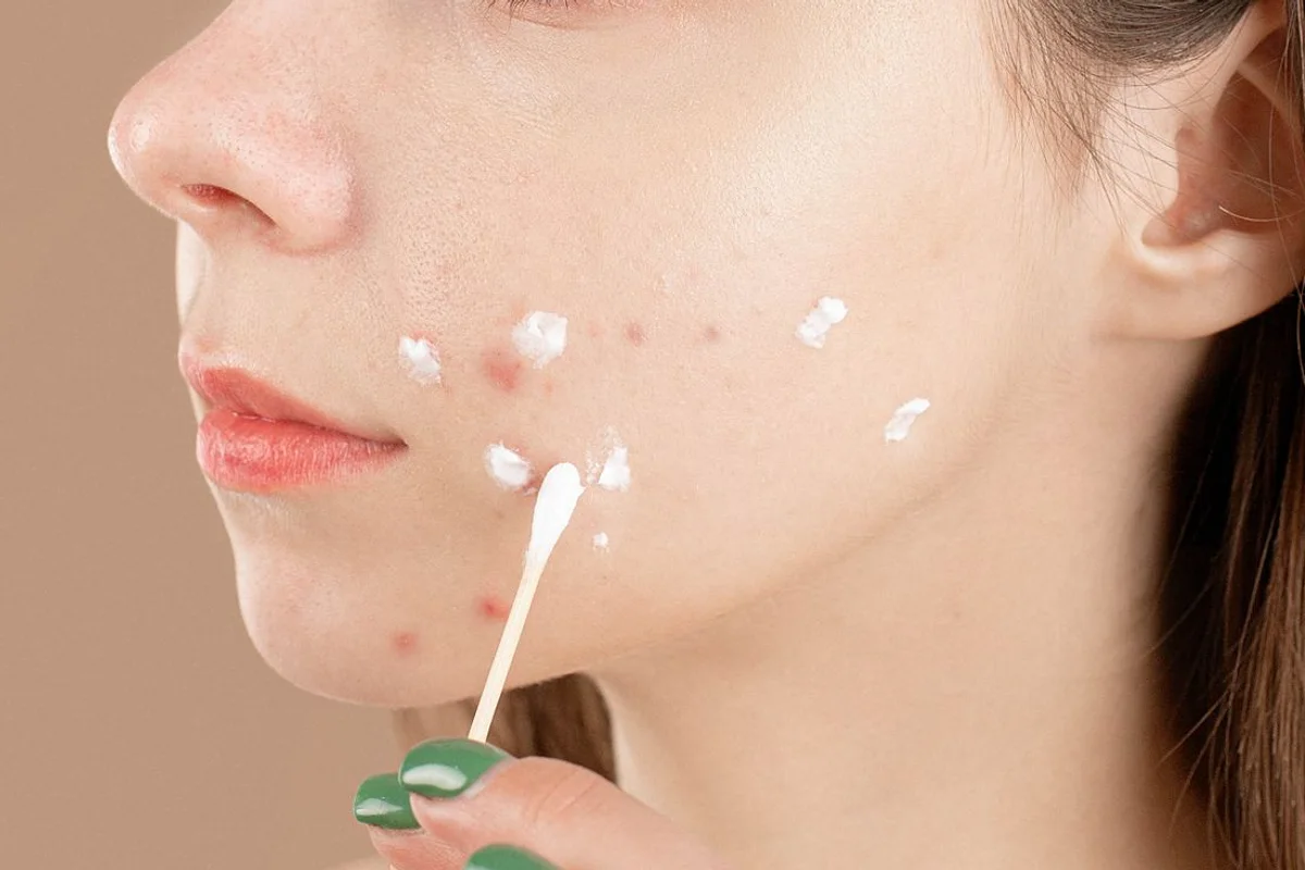 Topical cream dotted on acne-prone cheek skin, not a treatment result
