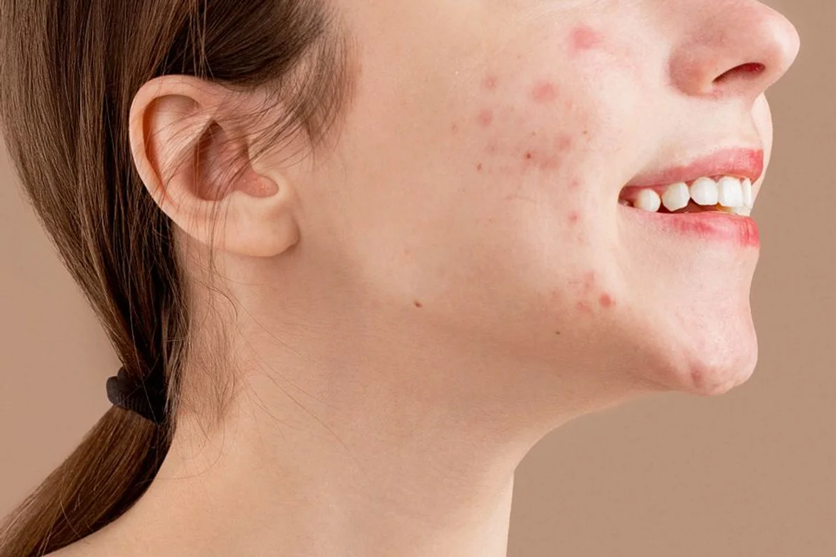 Close-up of acne marks on the cheek, not an acne-scar or treatment-result photo