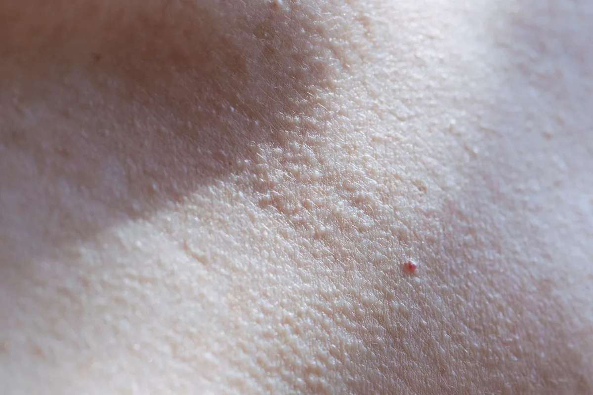 피부결이 보이는 피부 표면 확대 참고 사진. 시술 결과 사진 아님